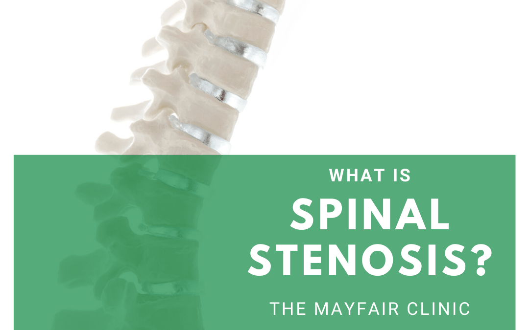 Treatment For Spinal Stenosis & Sciatica